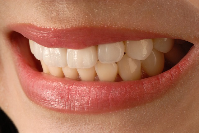 4. The Role of Veneers⁢ in Underbite Correction